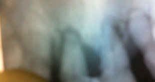 Diş eti hastalığı tedavisi