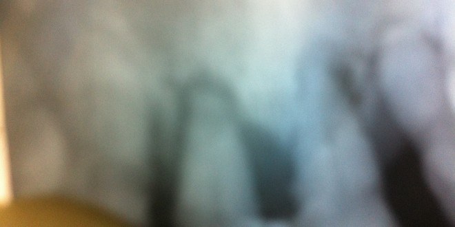 Diş eti hastalığı tedavisi