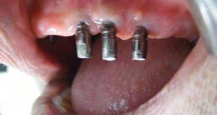 KÜÇÜKÇEKMECE İMPLANT DİŞ