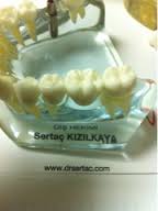 Estetik diş kaplama zirkonyum kaplama laminate veneer diş