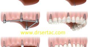 İmplant yapım süresi