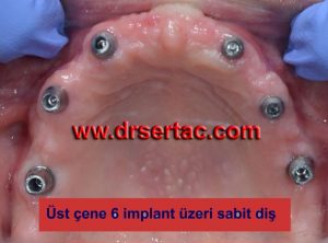 En iyi implant kendi dişimiz gibi olur mu?