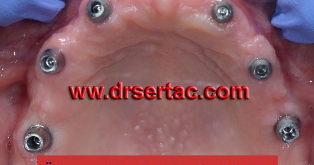 En iyi implant kendi dişimiz gibi olur mu?