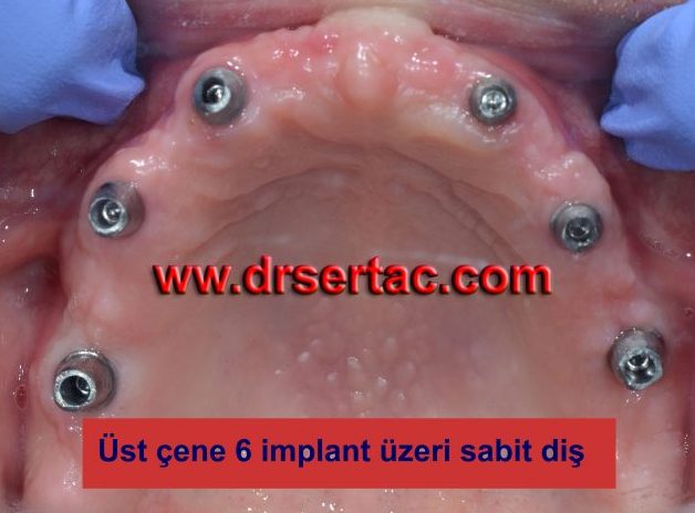 En iyi implant kendi dişimiz gibi olur mu?