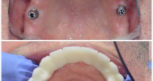 Üst çene implant yapımı