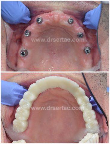 Üst çene implant yapımı