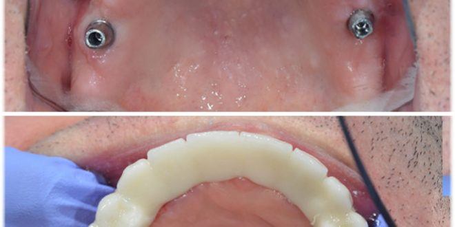 Üst çene implant yapımı